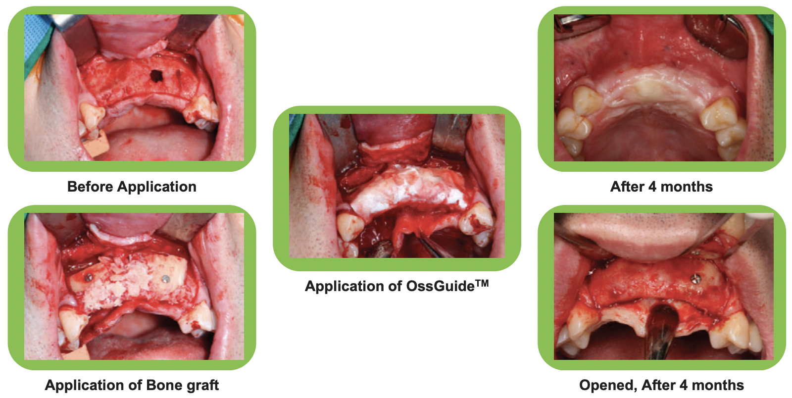 Màng xương tự tiêu cấy ghép Implant OssGuide HuynDai Bioland Hàn Quốc